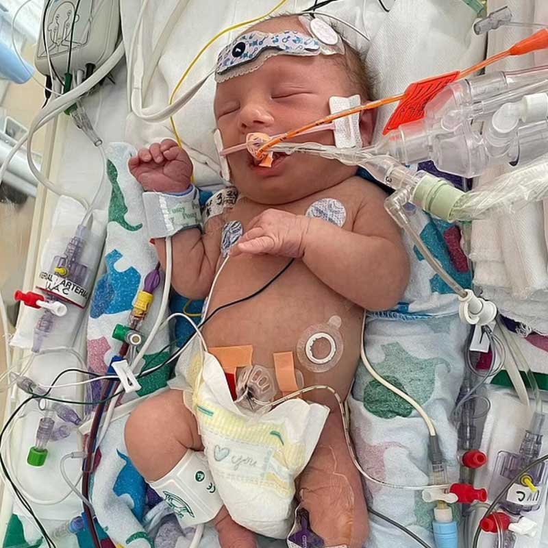 এমির ফুসফুস ছিল অপরিণত। সব মানুষের দুটো কিডনি থাকে। এমির একটিও কিডনি ছিল না। এই অঙ্গ শরীর থেকে বর্জ্য বার করে দেওয়ার কাজে লাগে। তা না থাকায় প্রাণসংশয় তৈরি হয় এমির।