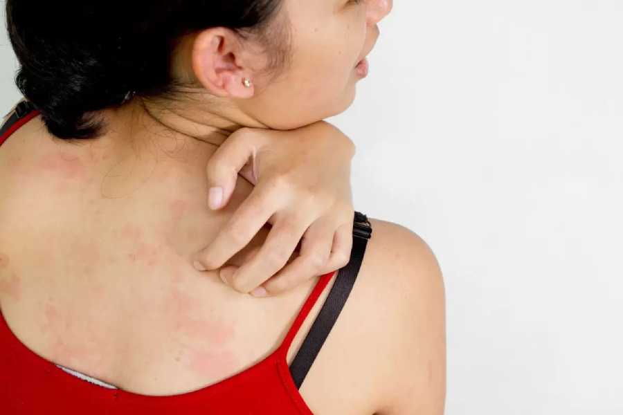 What is a stress rash? How to manage hives caused by anxiety.