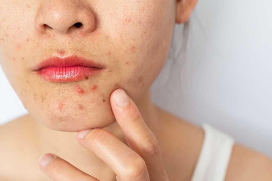Yoga can Help Treat Pimples and acne.