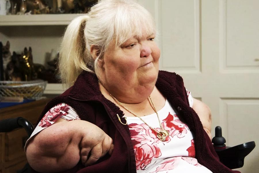 All you need to know about Thalidomide Tragedy