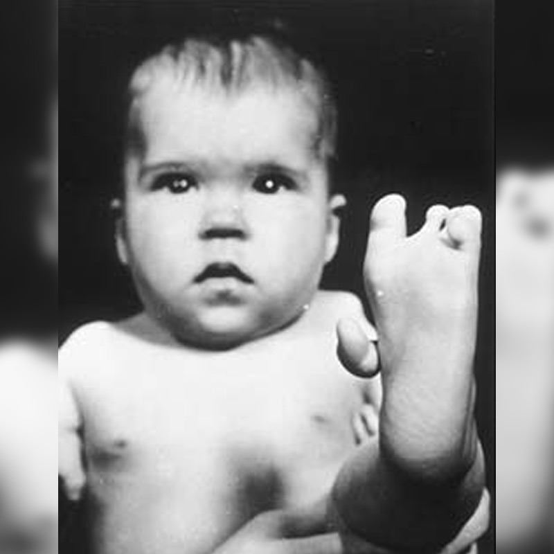 All you need to know about Thalidomide Tragedy