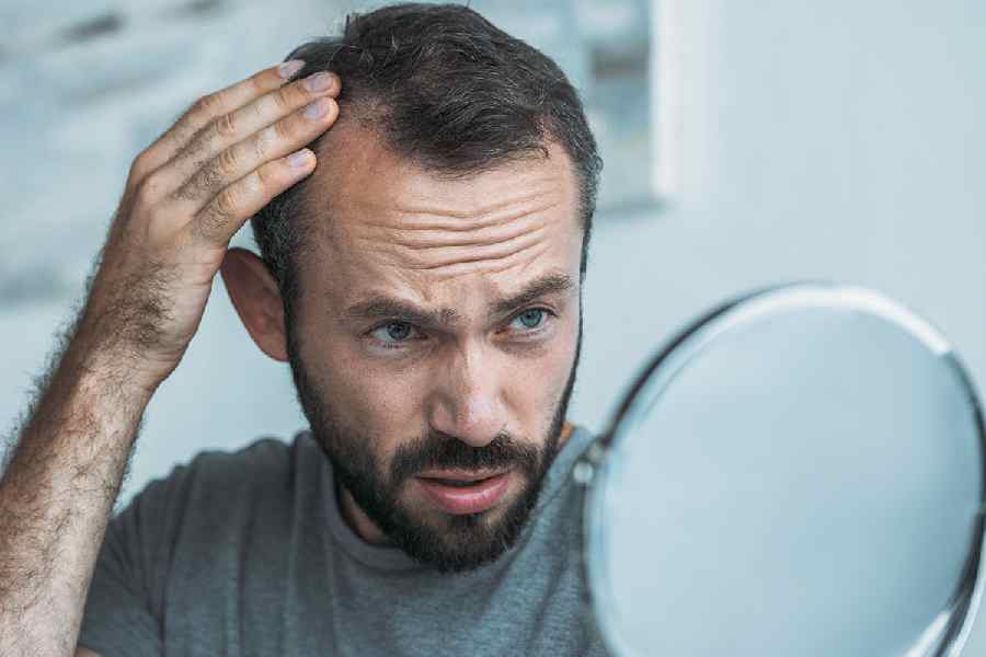 Daily habits of men that could be the reasons of hair loss.