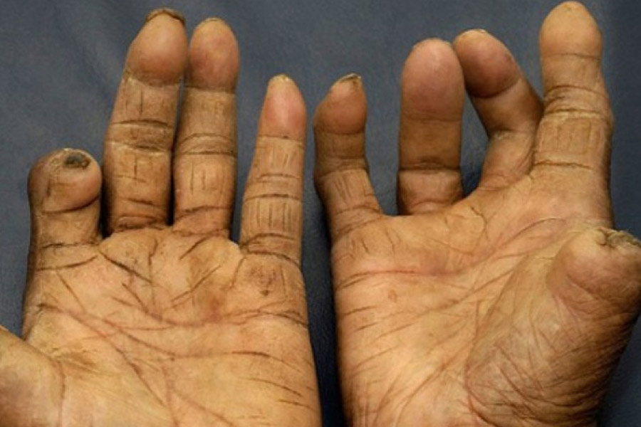 An image of Leprosy