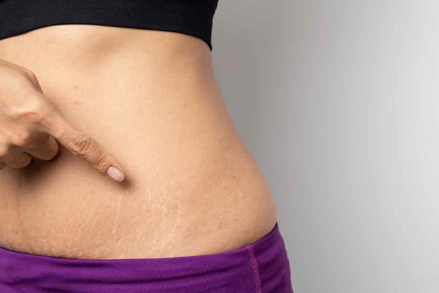 How to get rid of stretch marks permanently.