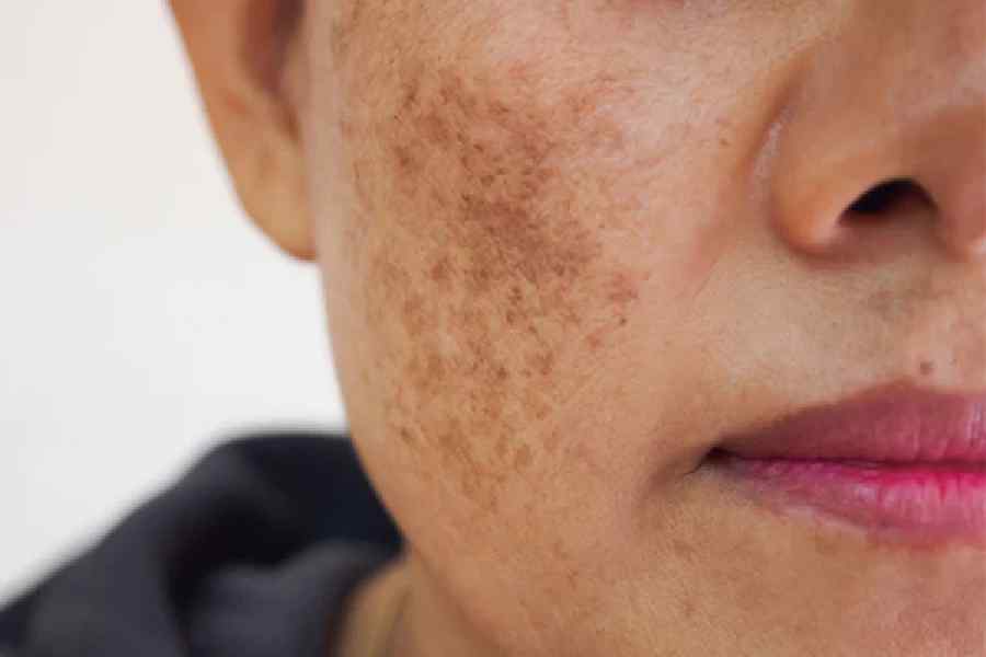 Factors that are causing dark spots and melisma on face.