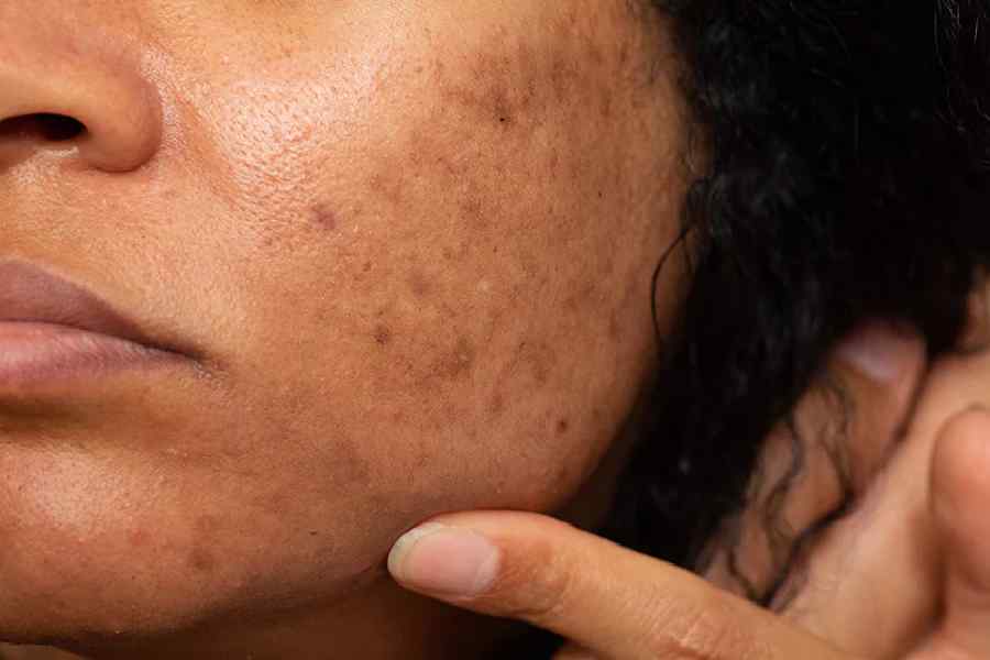 Try these three face packs to remove blemishes