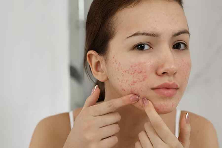 Image of Acne.