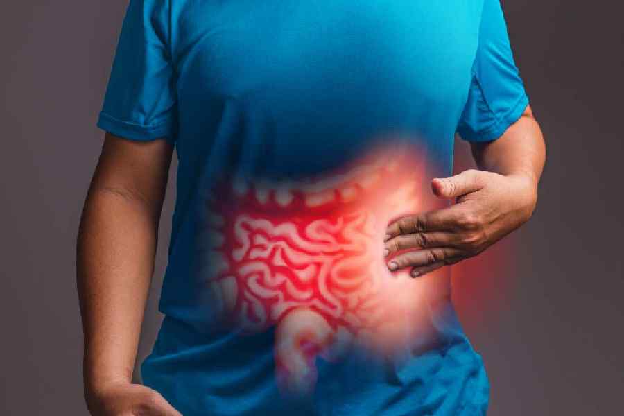 Early signs of colon cancer in young adults.