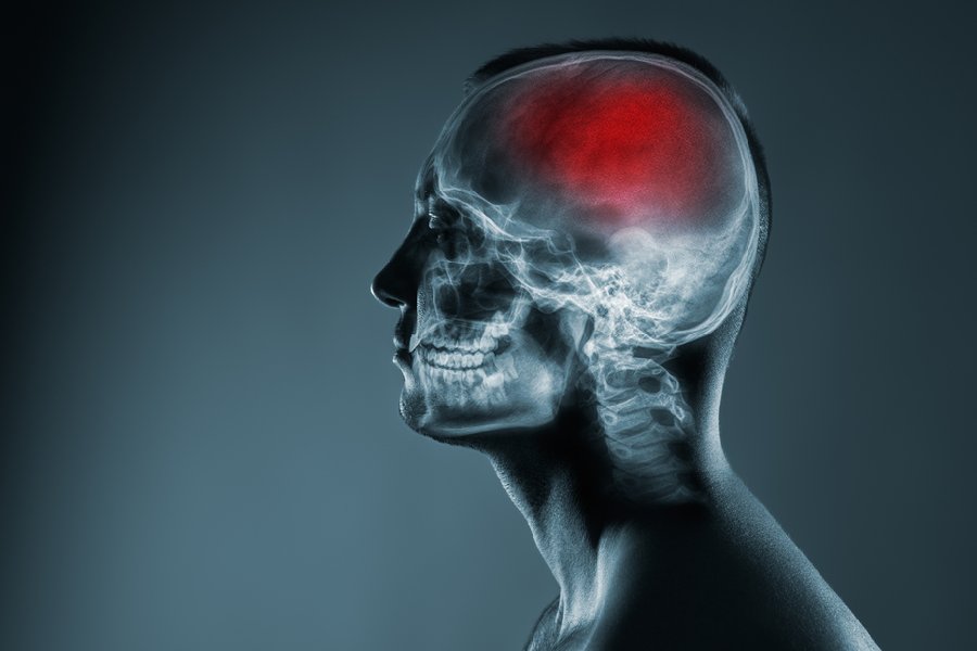 Lancet study states that India recorded 13 lakh stroke cases in 2019, which is highest in Southeast Asia.