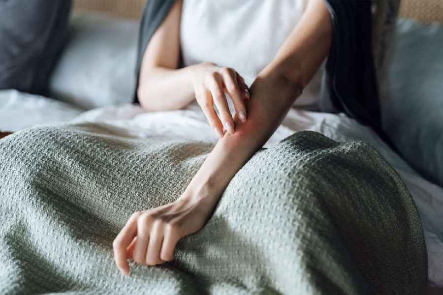 Skin disease could cause sleep disturbance; a study finds.