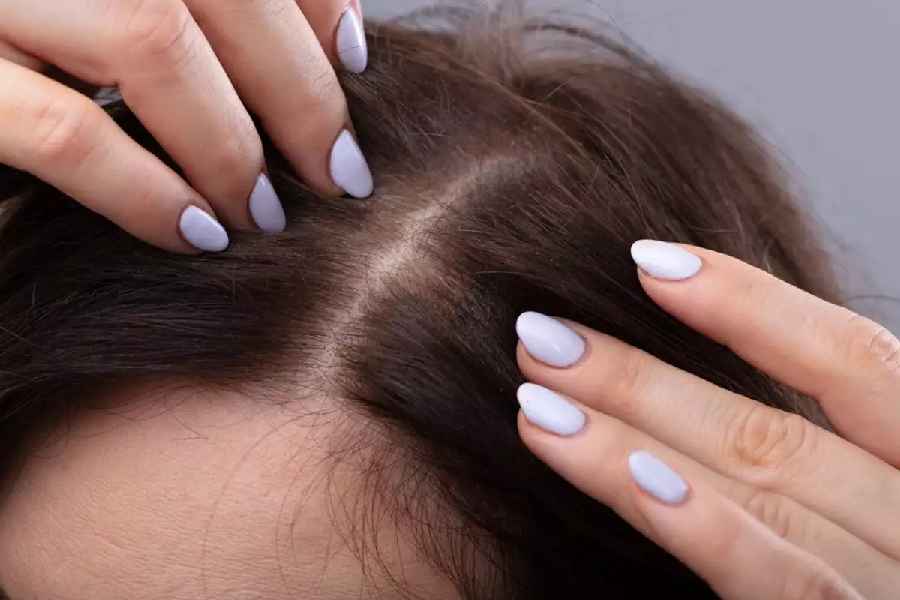 Tired of itchy acne on your scalp.