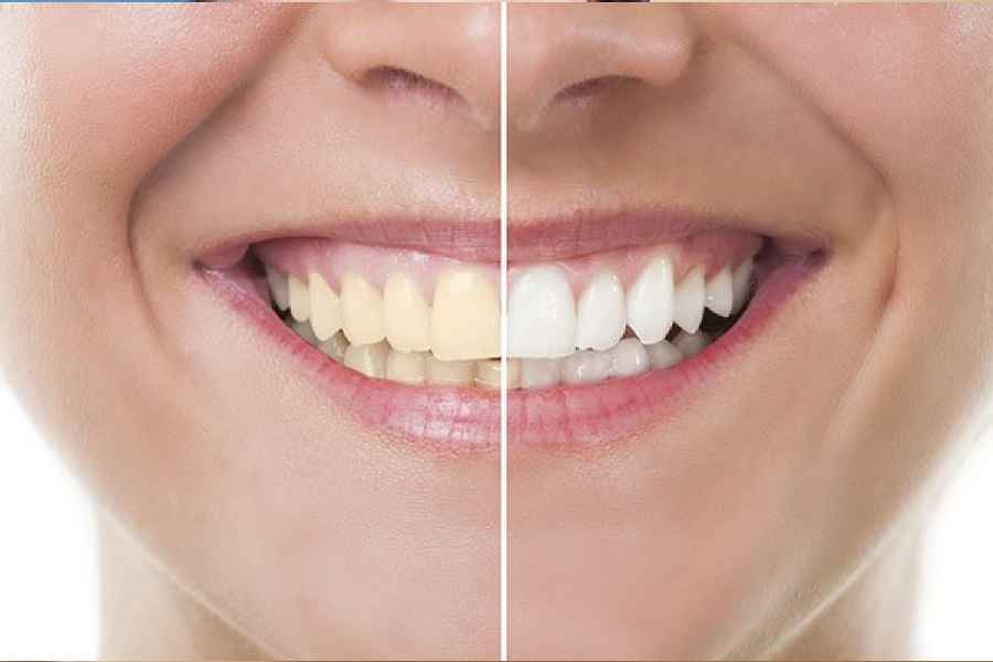 How to whiten your teeth naturally.