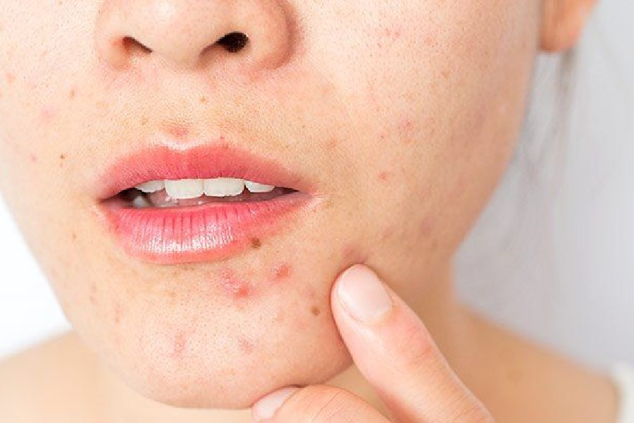 Image of Acne