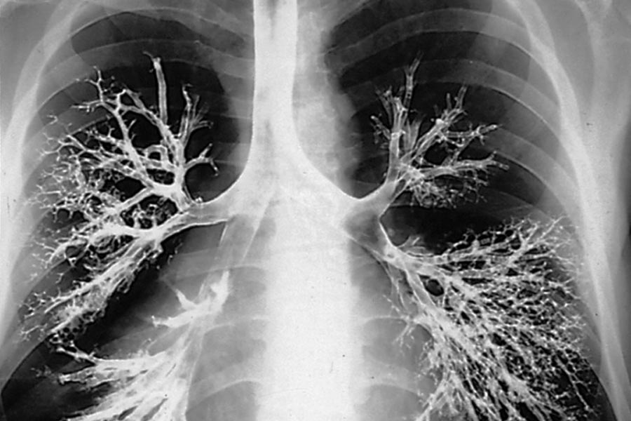 Image of Lung X-ray