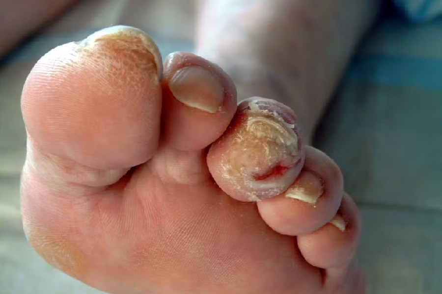 Image of Diabetic Foot