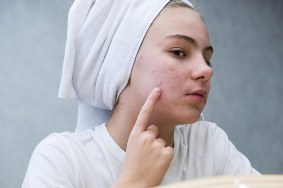 An image of pimples