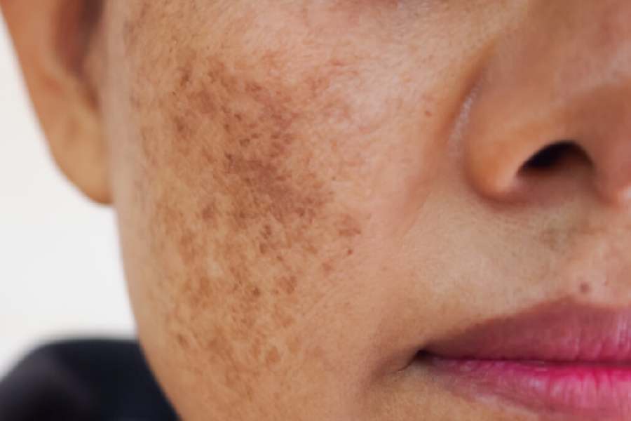 Health reasons and remedies for melasma on face