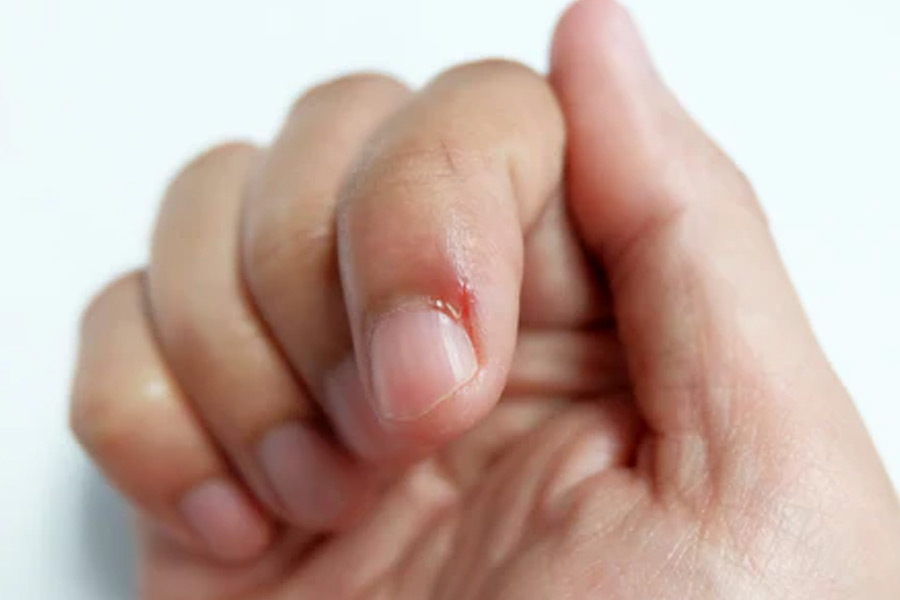 আবহাওয়া শুষ্ক থাকে বলে অনেক সময়েই ‘হ্যাংগনেল্‌স’-এর সমস্যা বাড়ে।