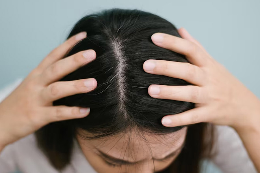 How to Prevent Sweaty Itchy Scalp in Summer dgtl