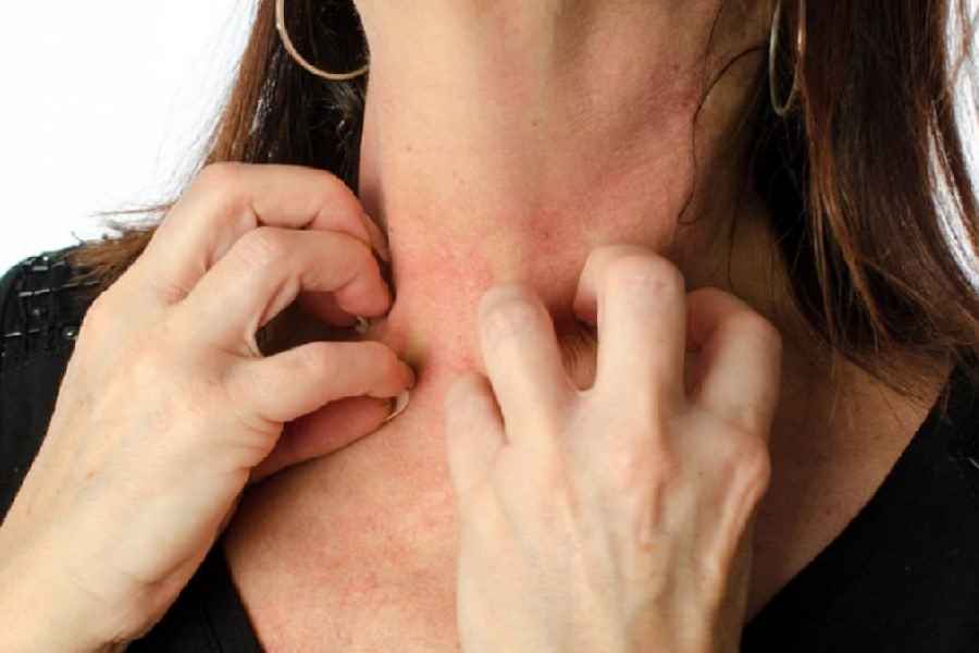 ত্বকের যে কোনও সমস্যায় চন্দন তেল ব্যবহার করা যেতে পারে।