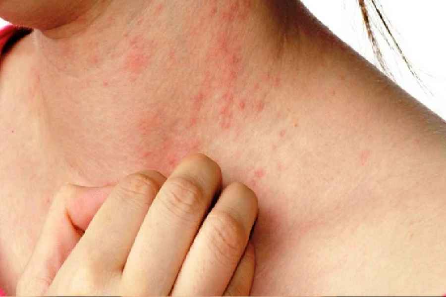 Tips on How to Manage Rashes Problem in Summer