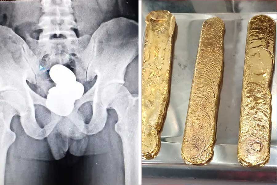 Gold worth 70 lakh found in man’s rectum at Trichy airport