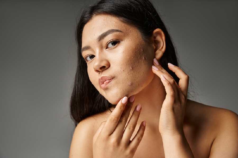 Five things to keep in mind when applying makeup on acne-prone skin