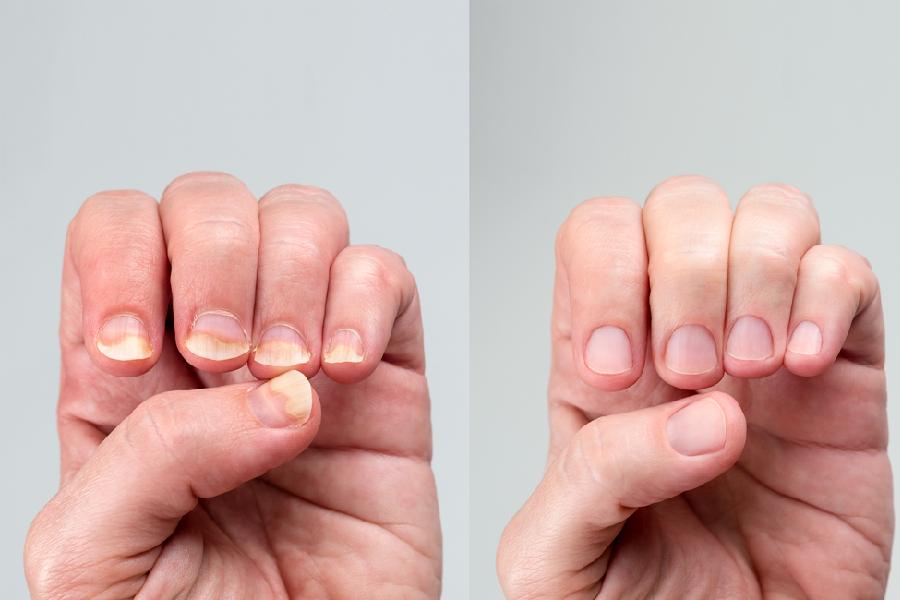 Your nails can reveal your health condition, so stop ignoring them dgtl
