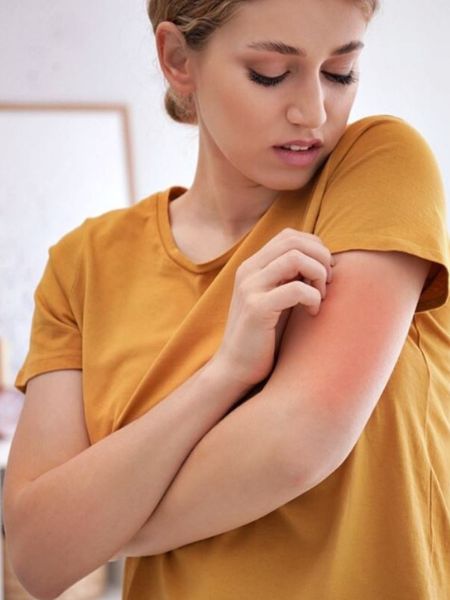 Home Remedies to reduce itching and burning in Summer dgtl