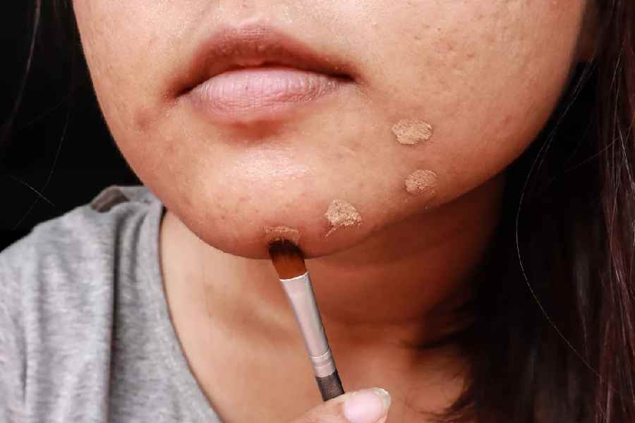 Tips you should follow while appling makeup for acne prone skin