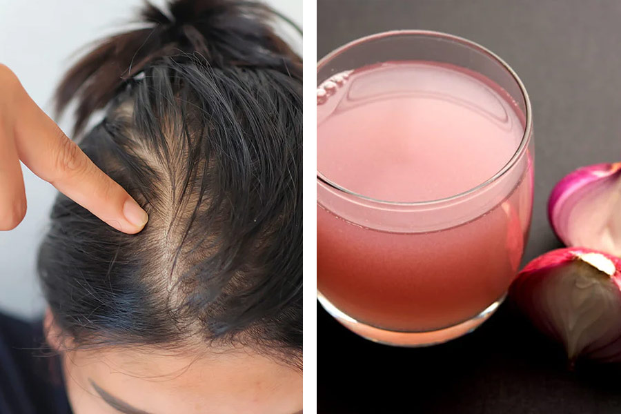 Side effects of onion juice for hair