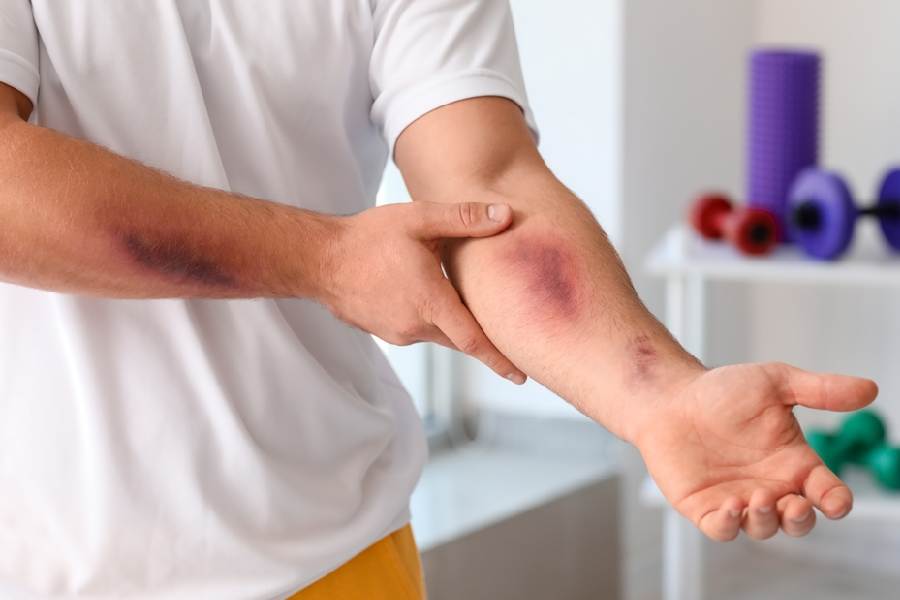 Reasons behind frequent bruising which you must not avoid