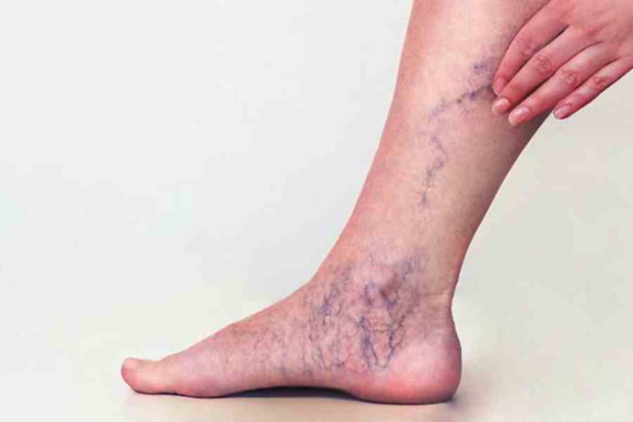 varicose veins condition affects almost 60% of women worldwide