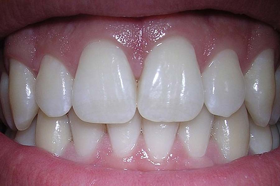 World’s expensive human tooth worth 30 lakh rupees