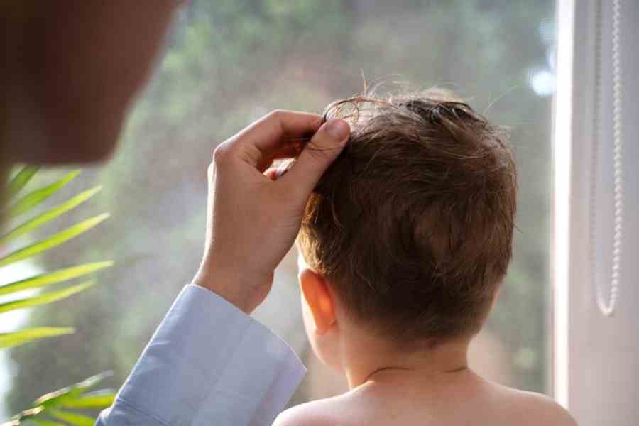 How to prevent scalp fungal infection in Kids