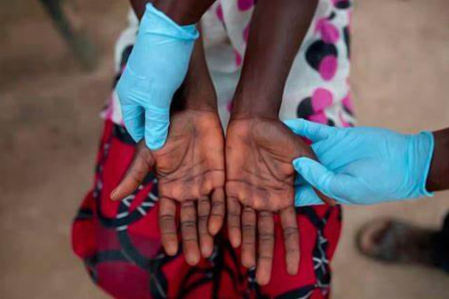 Uganda's district has been affected by a mysterious illness named dinga dinga 