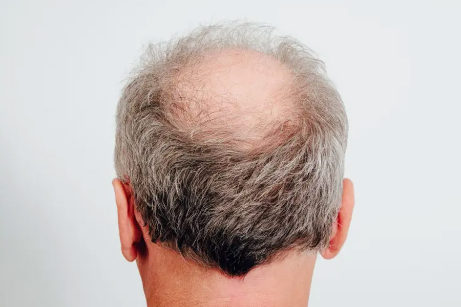 Four causes of baldness problem.