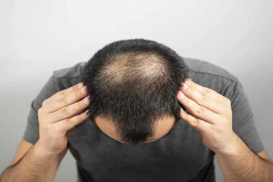 Men’s daily habits that lead to hair loss.