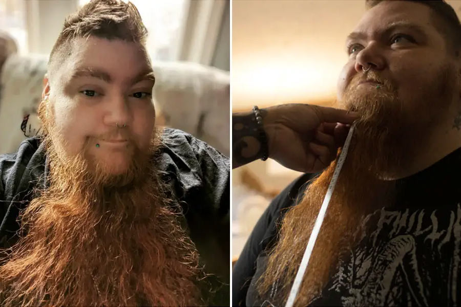 নারী হয়েও দাড়ি গজিয়েছে গালে। আমেরিকার মিচিগানের বাসিন্দা এরিন হানিকাট। বাইরে থেকে কোনও হরমোনের প্রয়োগে নয়, নিজে থেকেই এরিনের মুখে গজিয়ে ওঠে দাড়ি। 