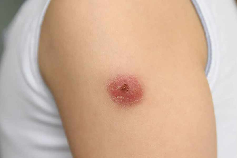 Symptoms and everything you need to know about Alaskapox