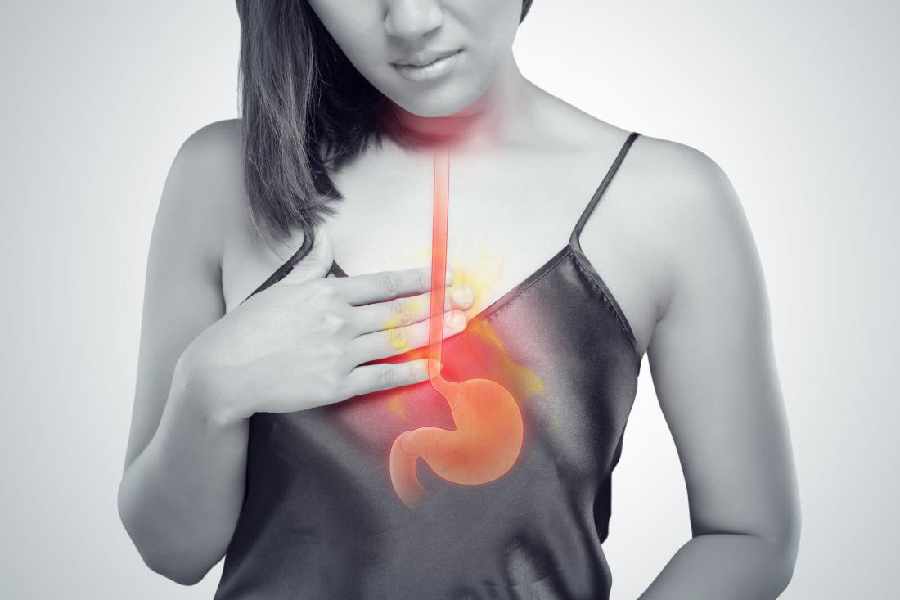 All you need to know about acid reflux and GERD
