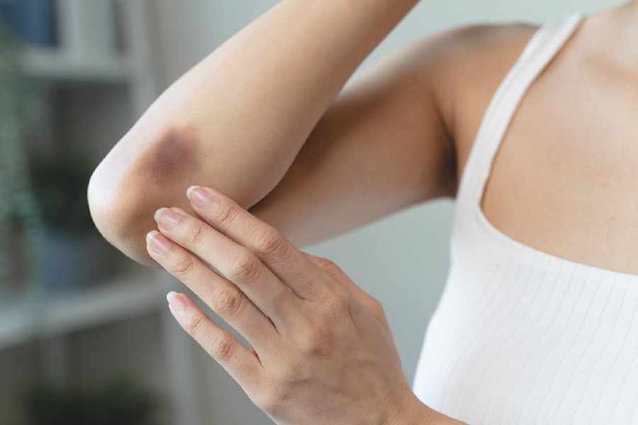 All you need to know the possible reasons behind bruises