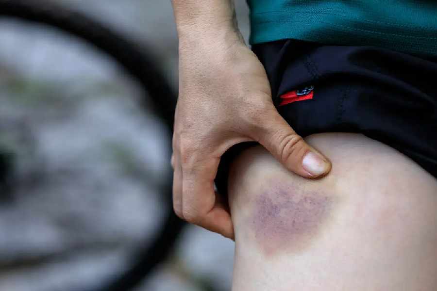 All you need to know the possible reasons behind bruises 