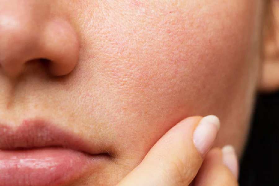 How to deal with open pores problem