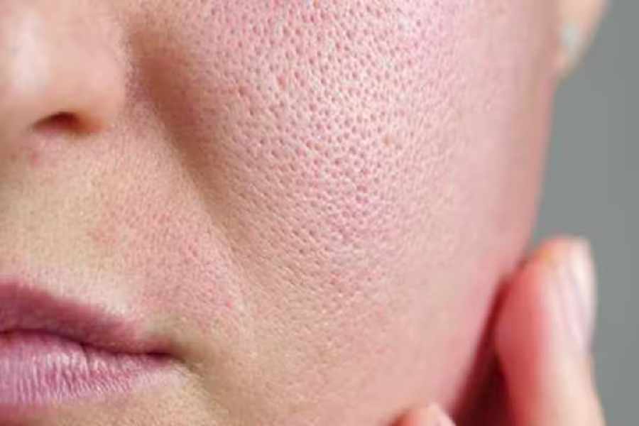 How to deal with open pores problem