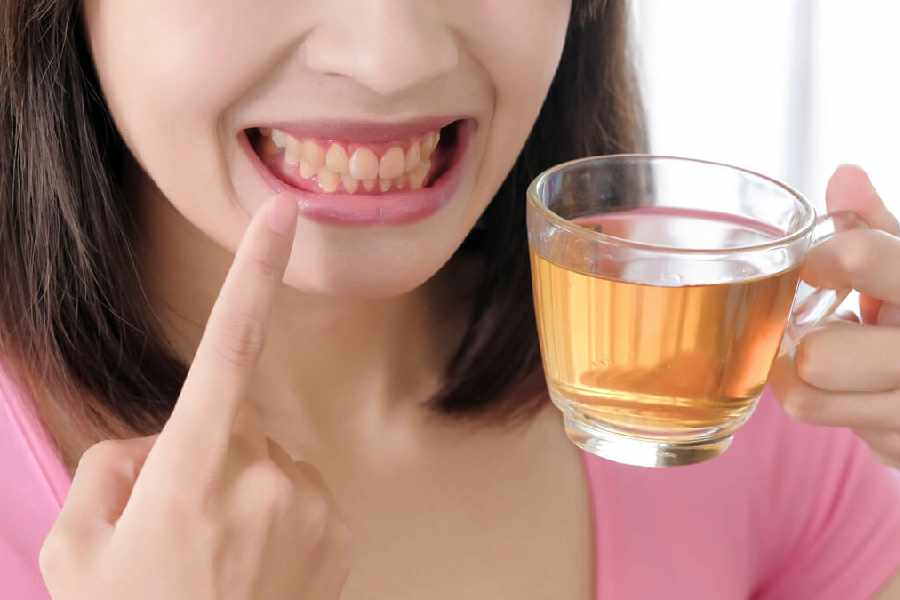 Foods you should avoid to maintain the white colour of your teeth