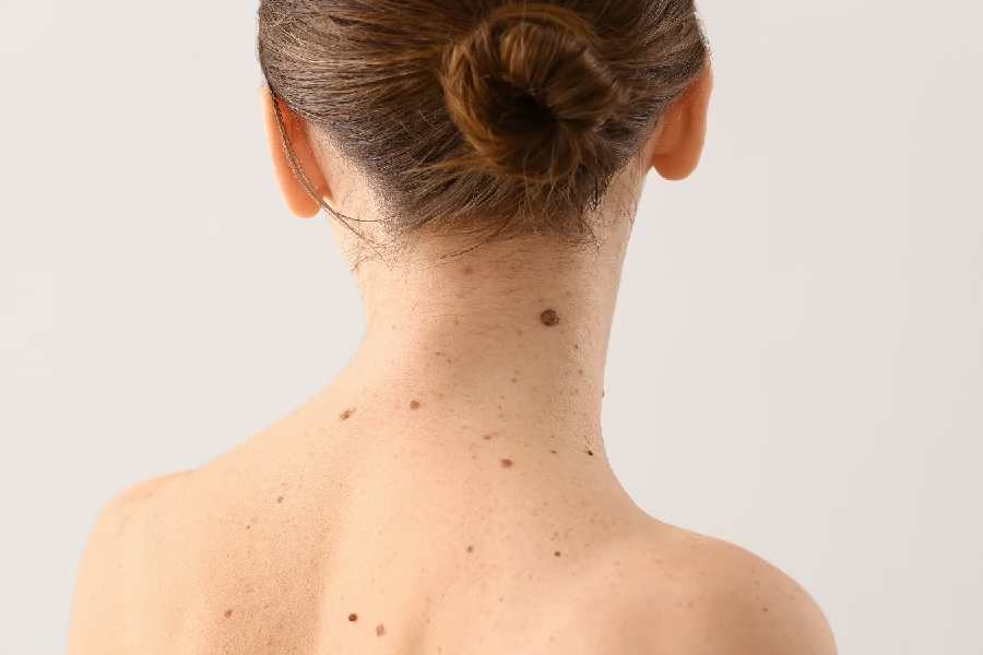 Should you be worried if too many moles start popping on my skin 
