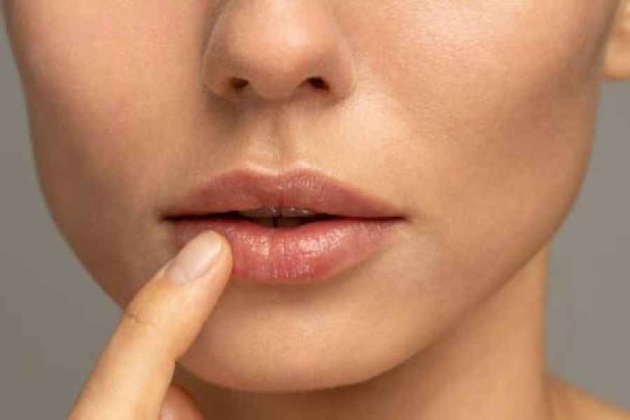 Common foods that can prevent and heal chapped lips.