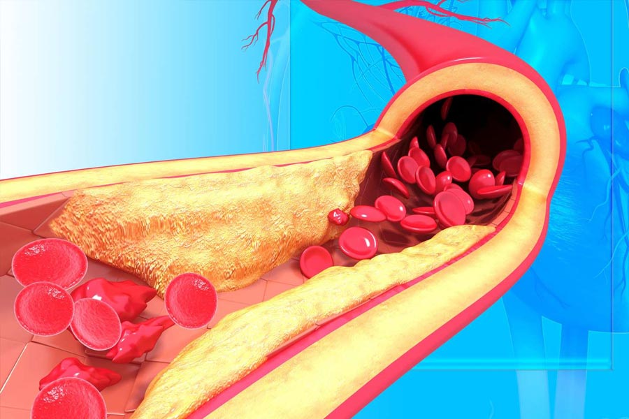 Healthy Habits That Can Help Flush Out Bad Cholesterol