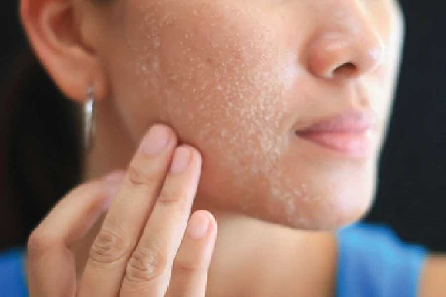 Five causes of dry skin around the year